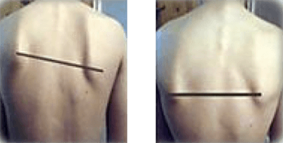 Avant / après soin Quantum Touch - exemple 2